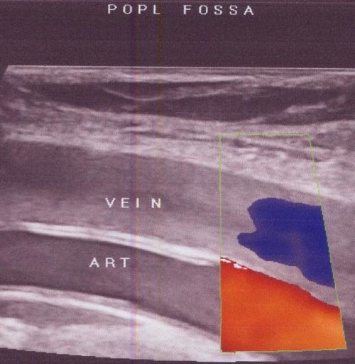 Colour Doppler image of popliteal artery and vein
