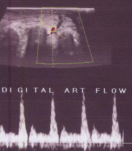 Digital artery Doppler flow