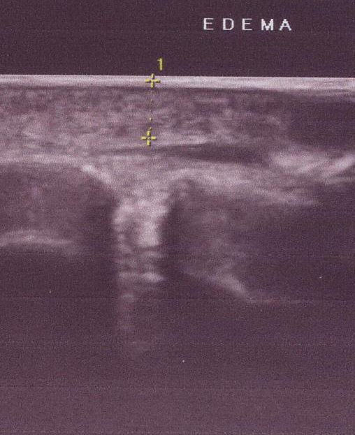 Ultrasound image of subcutaneous edema
