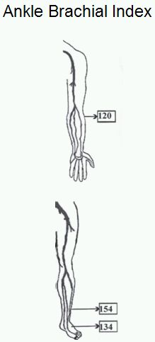 Ankle brachial index