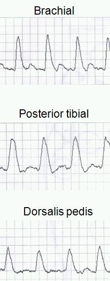 Brachial and ankle Doppler tracings