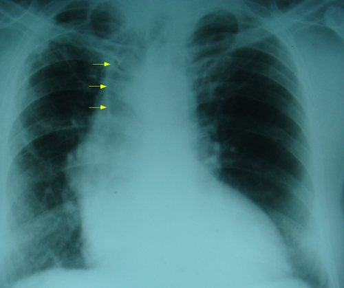 Tracheal shift to right on X-ray chest PA view