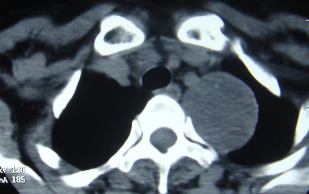 Posterior mediastinal mass on CT scan, to the left of the vertebra