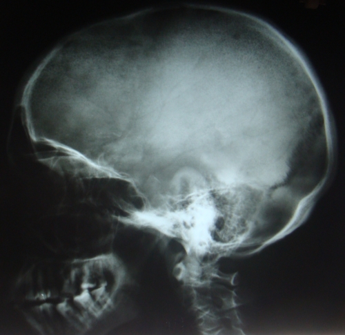 X-ray skull lateral view