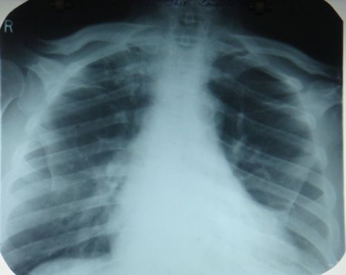 Apical lordotic view in chest X-ray
