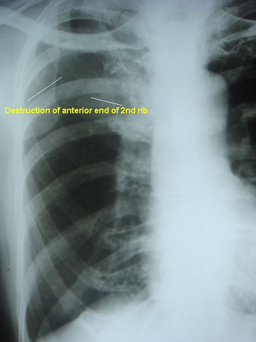 Destruction of anterior end of 2nd rib (right)