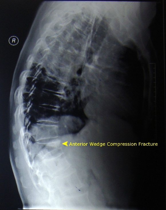 anterior wedge compression fracture vertebra