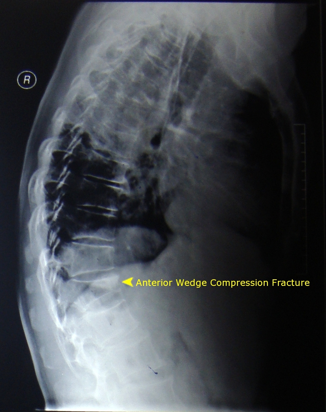 icd 10 code for anterior wedge compression fracture