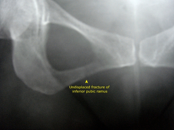 undisplaced fracture of inferior pubic ramus