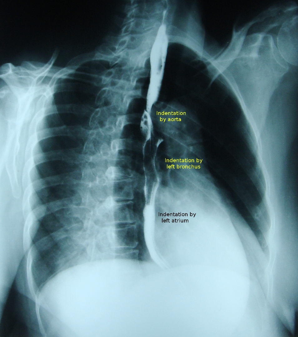 What is the barium swallow test used for?