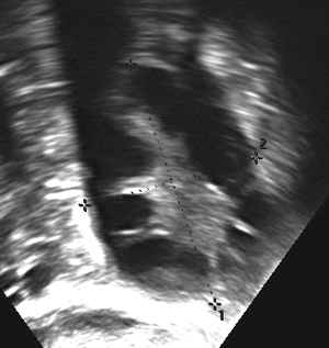 Polycystic ovarian disease (PCOD) ultrasound