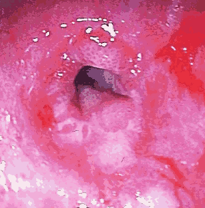 Stricture at gastroesophageal junction