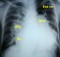 Differentiating an ASD from a VSD using a chest X-ray