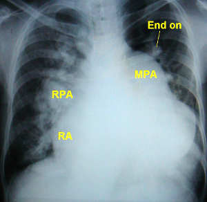 Ventricular Septal Defect X Ray