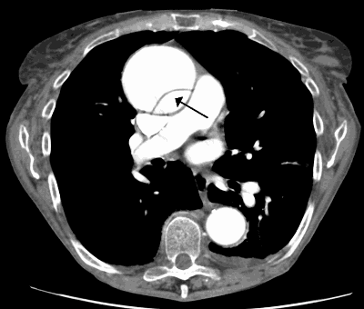 aortic dissection ct