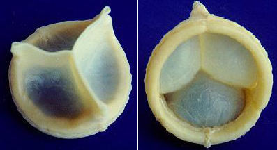 biological heart valve