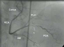 Dominant right coronary artery -angiogram