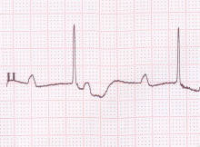 complete heart block ECG