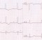 complete heart block ECG