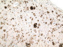 Alzheimer's disease - Abeta deposits in cerebral cortex