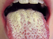 oral candidiasis
