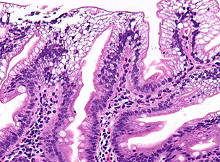 Abetalipoproteinemia duodenal mucosal biopsy