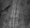 Bamboo spine in ankylosing spondylitis