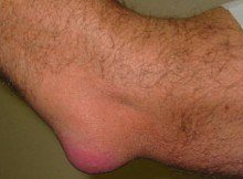 Clinical correlation: Elbow bursitis