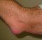 Clinical correlation: Elbow bursitis