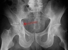 Acetabular fracture X-ray