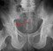 Acetabular fracture X-ray