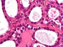 Clear cell adenocarcinoma - Ovary