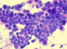 Papillary carcinoma thyroid - Histology