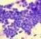 Papillary carcinoma thyroid - Histology
