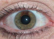 Partial heterochromia iridis