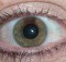 Partial heterochromia iridis