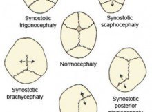 Types of craniosynostosis