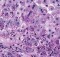 Alpha 1 antitrypsin deficiency - liver biopsy