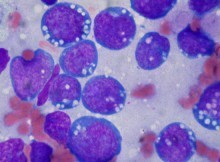 Burkitt lymphoma histopathology - Wright stain