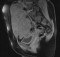 Desmoid tumour - MRI pelvis