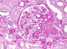 Focal segmental glomerulosclerosis