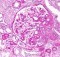 Focal segmental glomerulosclerosis