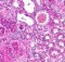 Rapidly progressive glomerulonephritis - Histopathology