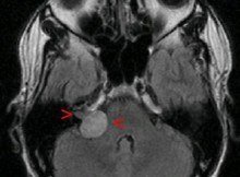 Acoustic neuroma - MRI