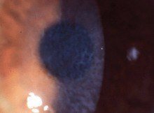 Reis Bucklers corneal dystrophy