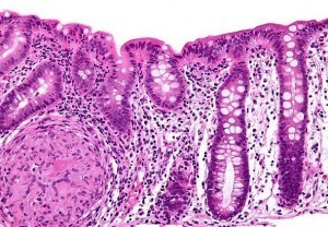 Protein losing enteropathy with mucosal erosion is seen in?