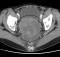 Ovarian cancer - CT scan