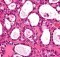 Ovarian clear cell carcinoma