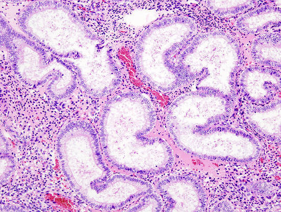 Pathology secretory endometrium Secretory phase