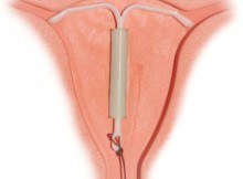 Mirena - progesterone releasing IUCD
